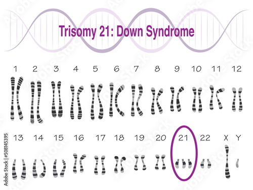 Trisomy 21 Down Syndrome Karyotype