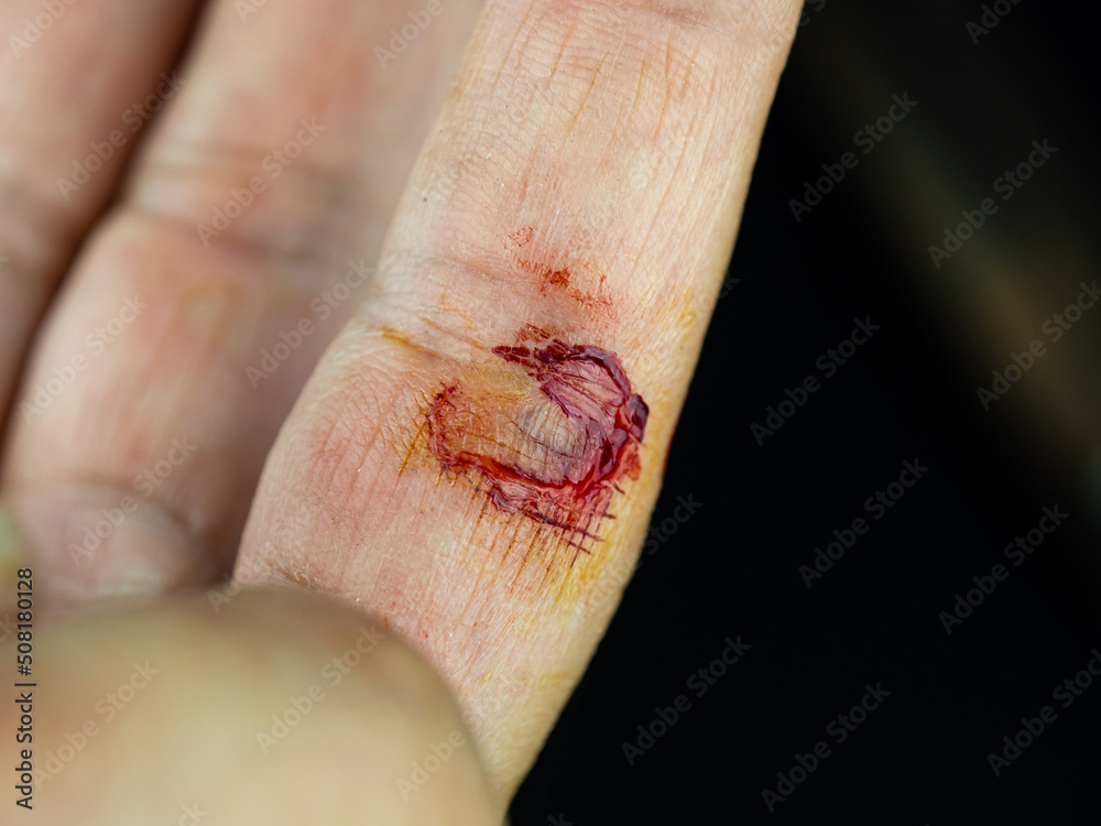 close-up cut injury. wound abrasion on finger while using scissors to cut the grass. close-up cut injury. wound abrasion on finger while using scissors to cut the grass.