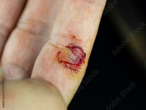 close-up cut injury. wound abrasion on finger while using scissors to cut the grass.