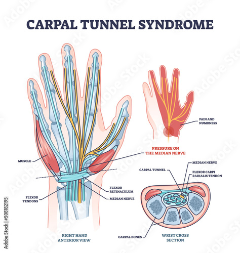 Carpal tunnel syndrome with median nerve pressure disease outline diagram. Labeled educational orthopedic condition from working with non ergonomic computer vector illustration. Occupational arm pain.