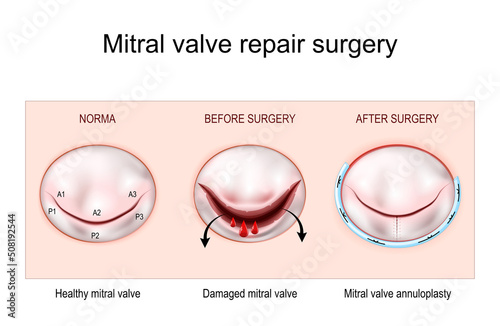 Mitral valve repair surgery photo