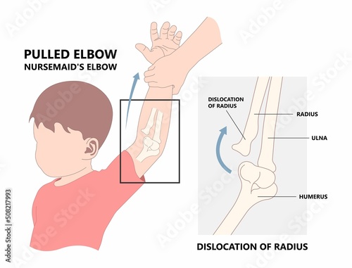 Child elbow dislocated injury that cause ulna bone fracture nursemaid painful head of radius subluxation young slight bend photo