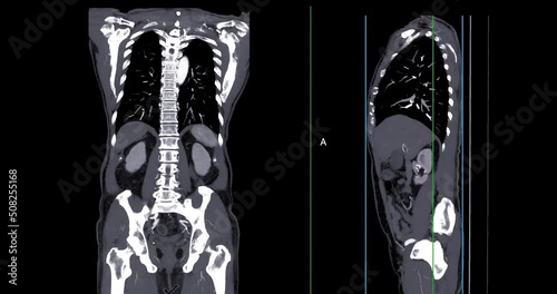 CT SCAN of Chest and Abdomen with injection contrast media for diagnonsis chest and abdomen disease. photo