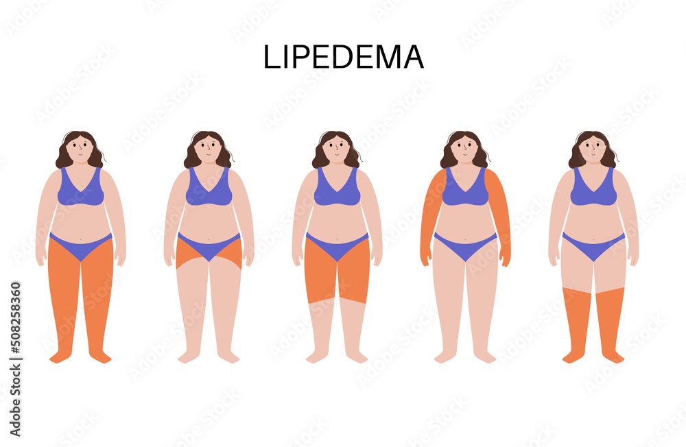 Fototapeta premium Lipedema fat zones