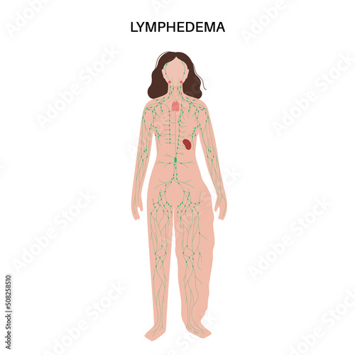 Lymphedema leg swelling