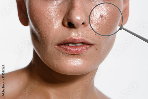 Nevus or pigment spot close-up on the skin of a female, white background