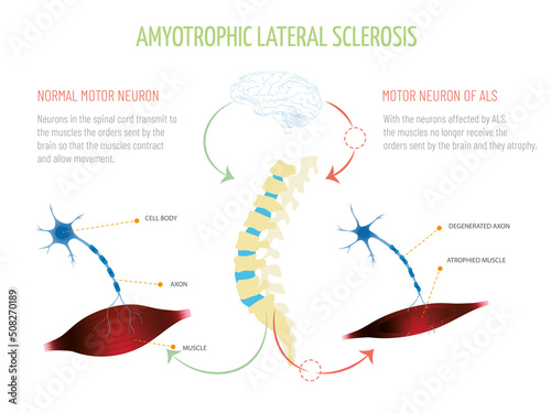 

Infographic about the functioning of the orders from the brain to the muscles with and without amyotrophic lateral sclerosis.