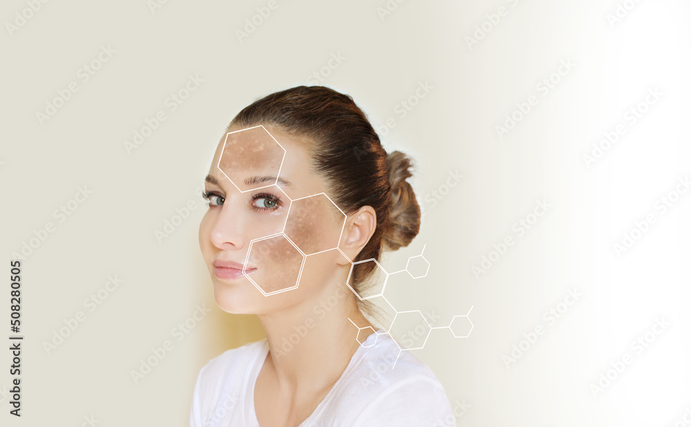 Dark spots, freckles,hyperpigmentation(melasma or chloasma),concept - skin lightening, skin whitening, fruit acids,AHA, Skin Brightening Dark spots, freckles,hyperpigmentation(melasma or chloasma),concept - skin lightening, skin whitening, fruit acids,AHA, Skin Brightening