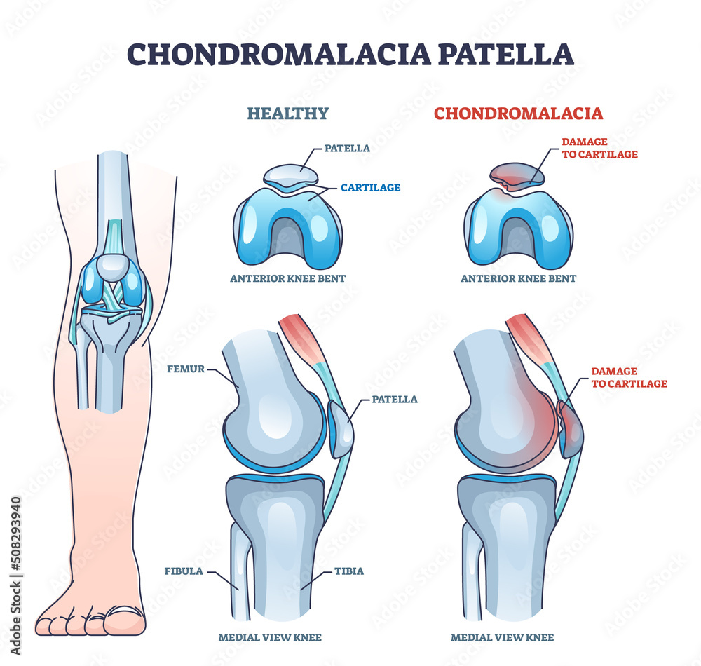 Chondromalacia patella knee breakdown compared with healthy outline diagram. Labeled educational kneecap tissue damage with cartilage problem and anatomical leg joint structure vector illustration. - obrazy, fototapety, plakaty 
