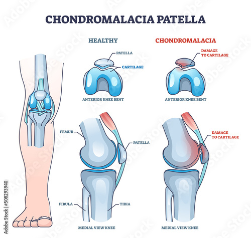 Chondromalacia patella knee breakdown compared with healthy outline diagram. Labeled educational kneecap tissue damage with cartilage problem and anatomical leg joint structure vector illustration. photo