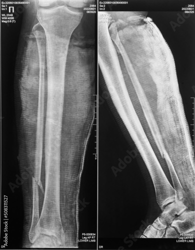 Radiograph of a comminuted fracture of the lower leg with displacement and in two projections, vertical image