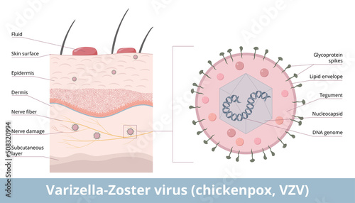 Varicella-Zoster virus (chickenpox, VZV). Detailed scheme of Varizella-Zoster virion, including DNA genome, nucleocapsid, and glycoprotein spikes. Viral infection in skin layer through nerve fiber. photo