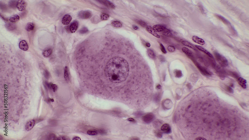 Pseudounipolar neurons. Pseudounipolar neurons of rounded soma of a dorsal root ganglion.Сell body is surrounded by glia cells called satellite cells. Hematoxlyn and eosin stain. Magnification: x1000.