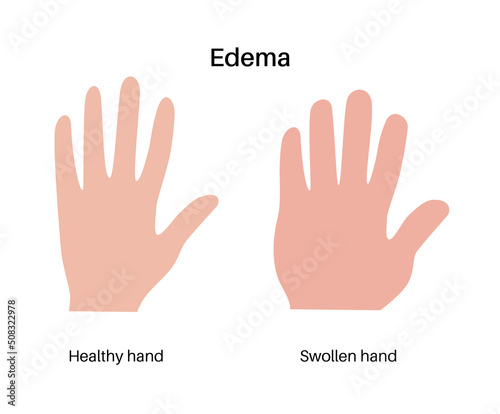 Edema of arm