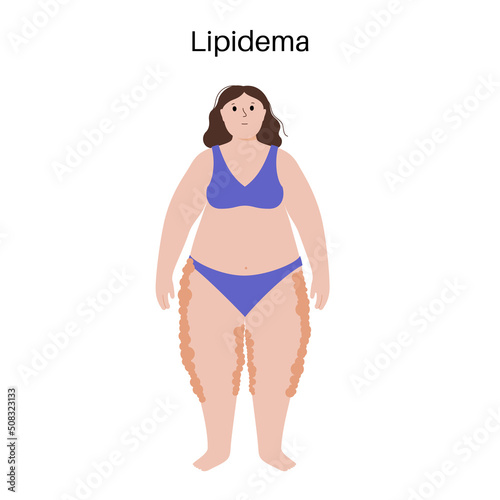Lipedema fat zones