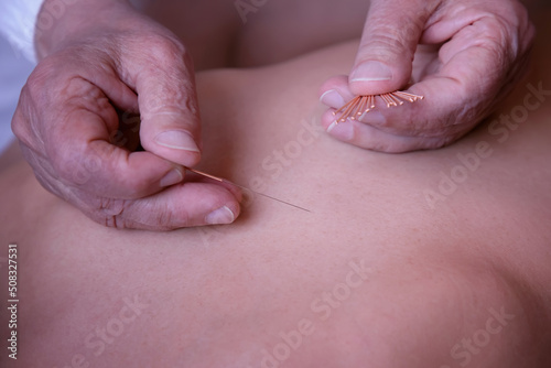 Back acupuncture of a woman. Acupuncturist doctor applies a needle into the skin of the patient lying on the medical bed