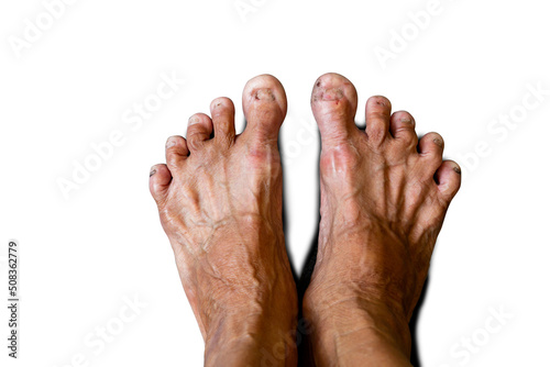 Old people's feet with fungal nails. foot screening test, diabetes health promotion