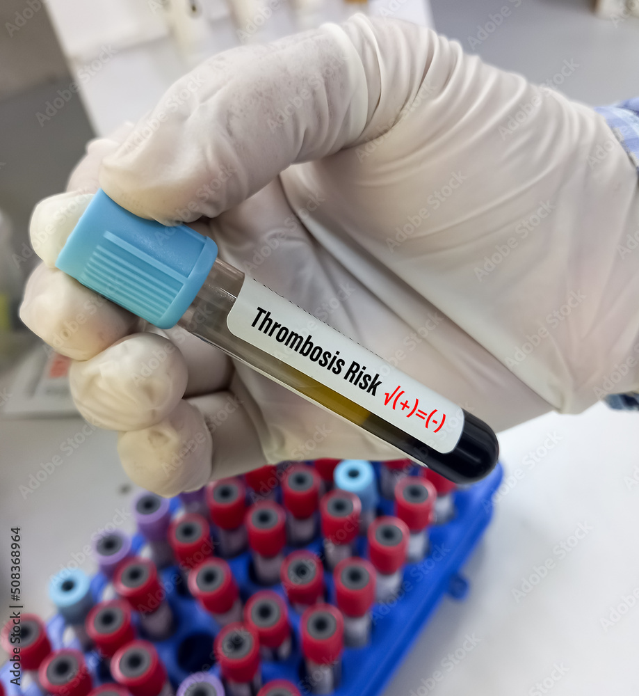 Technologist holding blood sample tube for Thrombosis risk test to