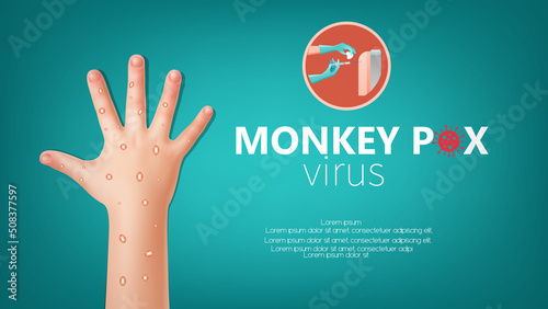 Monkeypox are shown on the patient's hand, Monkeypox virus spreading around the world medical background. Poster design in vector illustration.