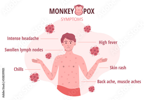 Monkey pox outbreak. Infographics of virus symptoms in humans. Vector illustration for informing people about an infectious disease