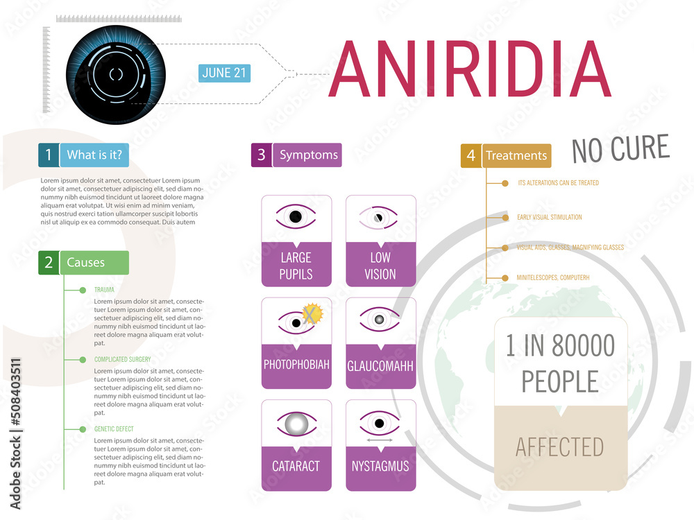 Naklejka premium Infographics about aniridine disease, causes, symptoms and treatment.