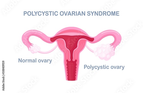 Polycystic ovary syndrome. PCOS hormonal diagnose. Female reproductive system with ovary, uterus, fallopian tubes. Female organs disease. Vector design