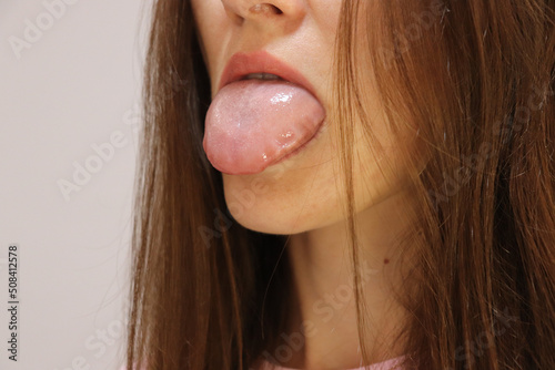 Woman shows large swollen tongue. Allergic reaction with Quincke's edema or Gastroesophageal reflux disease. photo