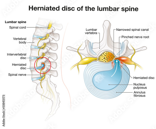 Herniated disc of the lumbar spine, stenosis, slipped disc. Medical illustration photo
