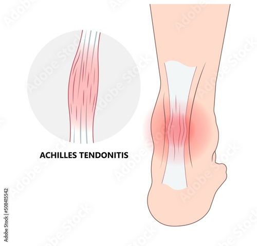 Rupture of Achilles tendon injury Feet calf test range of motion slight ache problem limb Thompson Simmonds torn photo