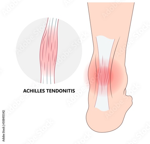 Rupture of Achilles tendon injury Feet calf test range of motion slight ache problem limb Thompson Simmonds torn