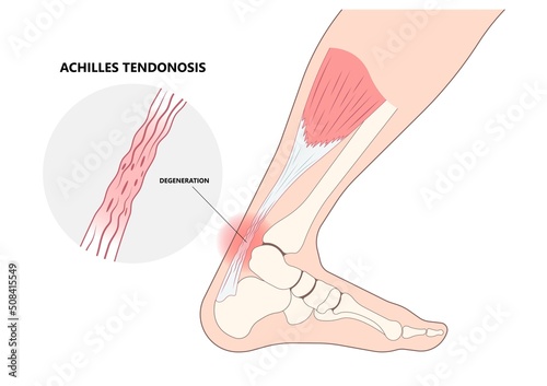 Small tear of Achilles tendon injury Feet calf test range of motion slight ache problem limb Thompson Simmonds and torn Rupture photo