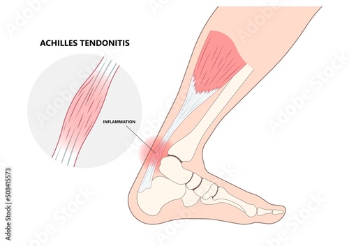 Inflammation of Achilles tendon injury Feet calf test range of motion slight ache problem limb Thompson Simmonds and torn Rupture  photo