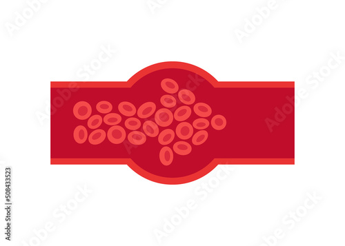 Deep vein thrombosis DVT , artery and vein disease, abnormally of blood vascular flow. World Thrombosis Day. Cholesterol blocked in human blood vessel. Vector illustration