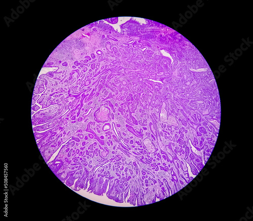 Histological slide under microscopy showing Pedunculated squamous papilloma. photo