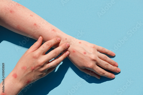 Monkeypox new disease dangerous over the world. Patient with Monkey Pox. Painful rash, red spots blisters on the hand. Close up rash, human hands with Health problem. Banner, copy space. Alaskapox photo