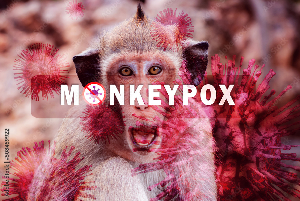 Monkeypox outbreak concept. Monkeypox is caused by monkeypox virus