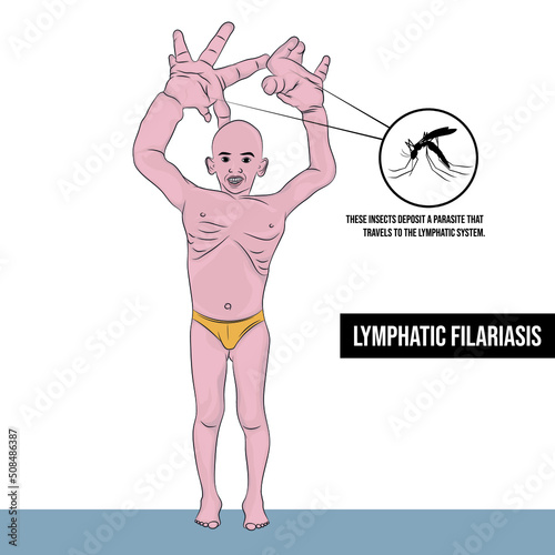 Lymphatic filariasis or elephantiasis is spread by infected mosquitoes, infecting the skin and lymphatic tissue. photo
