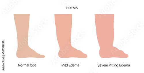 Edema of feet