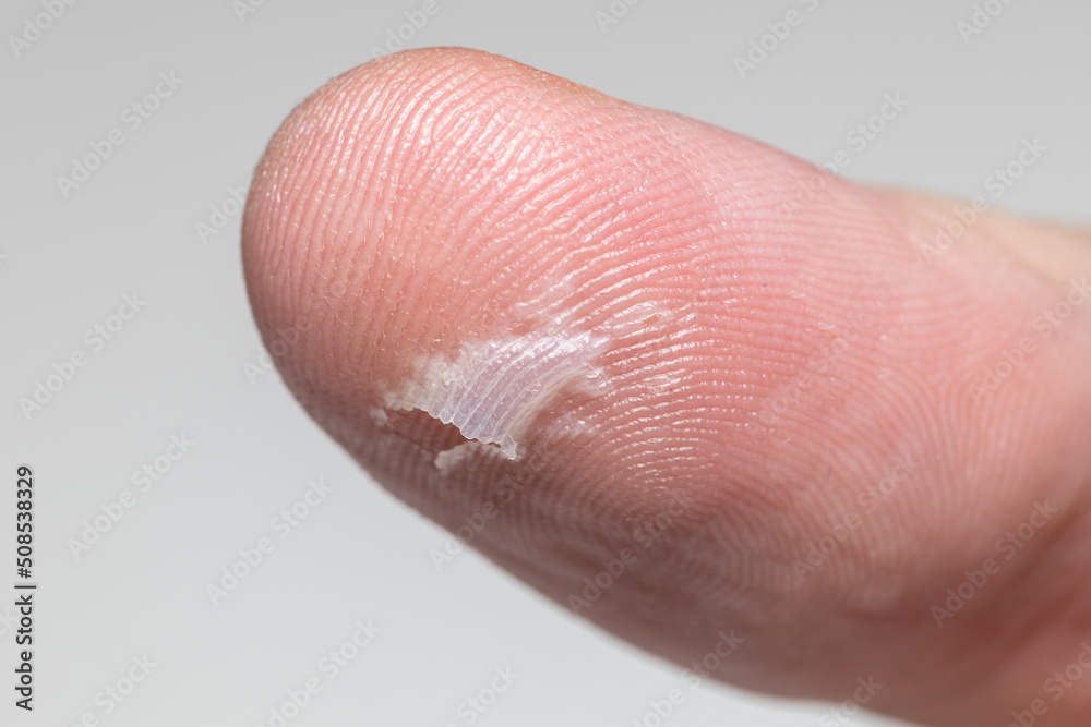 Fototapeta premium A burst blister on the thumb of a Caucasian man. Mechanical damage to the skin on the thumb of a man. Dermatological problem