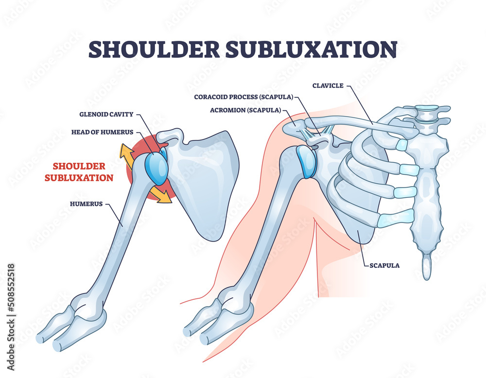 Vektorová grafika „Shoulder subluxation as partial dislocated arm joint