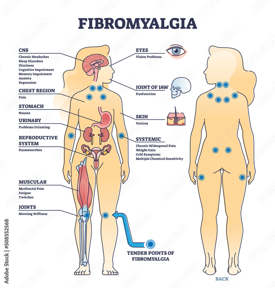 Fibromyalgia As Musculoskeletal Pain Disorder Tender Points Outline Fibromyalgia as musculoskeletal pain disorder tender points outline