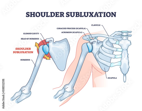 Shoulder subluxation as partial dislocated arm joint problem outline diagram. Labeled educational medical scheme with body skeletal anatomy and dislocated bones vector illustration. Upper body trauma. photo