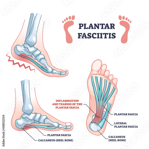 Plantar fasciitis as fascia muscle inflammation and tearing outline diagram. Labeled educational scheme with painful foot condition and medical xray explanation vector illustration. Feet skeleton. photo