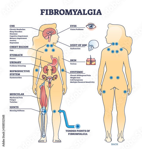 Fibromyalgia as musculoskeletal pain disorder tender points outline diagram. Labeled educational scheme with widespread medical body problems from FMS condition vector illustration. Symptoms list. photo
