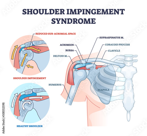 Shoulder impingement syndrome from rubbing rotator cuff outline diagram. Labeled educational scheme with painful and healthy muscular system comparison vector illustration. Upper body skeleton problem photo