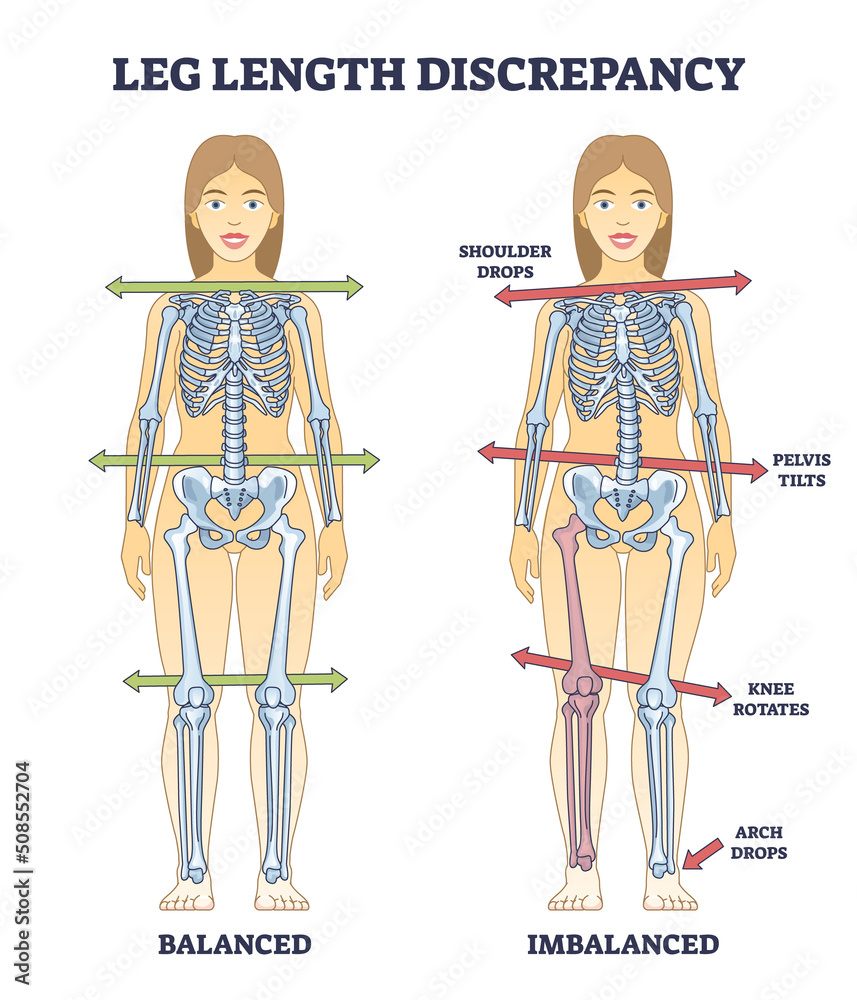 Leg length discrepancy condition with imbalanced skeleton outline diagram. Labeled educational scheme with bones asymmetry and comparison with balanced body vector illustration. Posture symptoms. - obrazy, fototapety, plakaty 