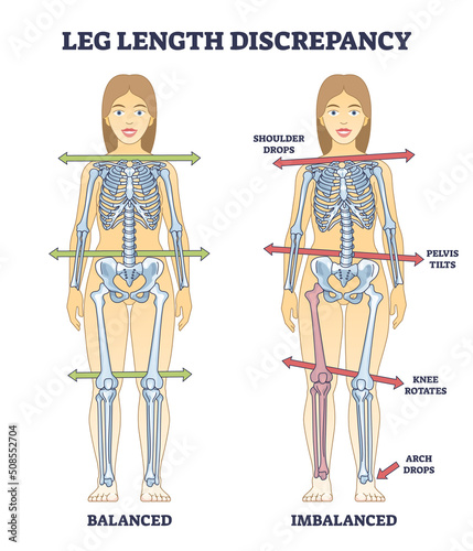 Leg length discrepancy condition with imbalanced skeleton outline diagram. Labeled educational scheme with bones asymmetry and comparison with balanced body vector illustration. Posture symptoms.