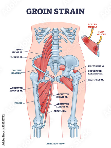 Groin strain trauma and pulled or torn muscle injury anatomy outline diagram. Labeled educational medical sport problem explanation with body hips and leg overstretching condition vector illustration. photo