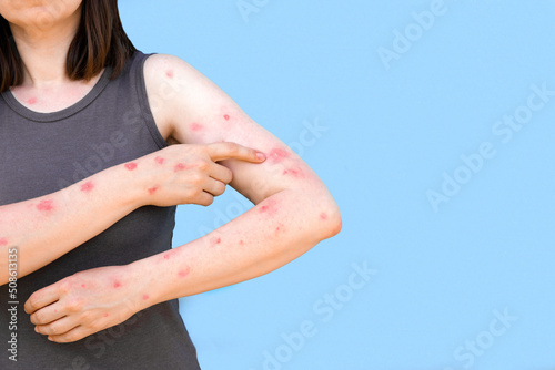 Monkeypox new disease dangerous over the world. Patient with Monkey Pox. Painful rash, red spots blisters on the hand. Close up rash, human hands with Health problem. Banner, copy space photo