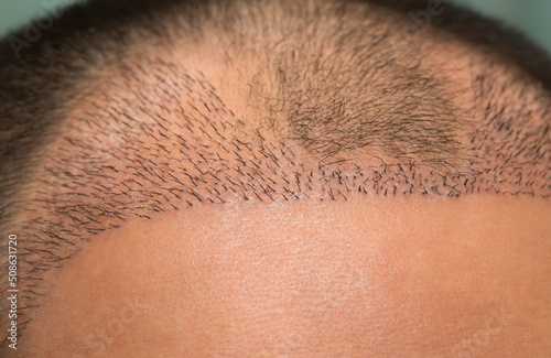 Quadro su tela Close up top view of a man's head with hair transplant surgery with a receding hair line